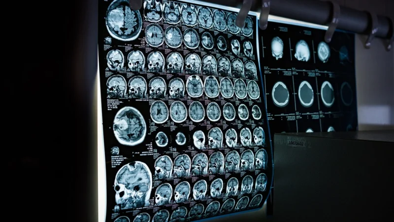 Nowoczesne podejścia w leczeniu chorób neurodegeneracyjnych